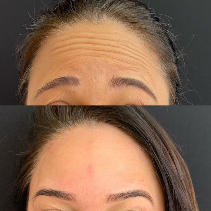 Resultado de Botox